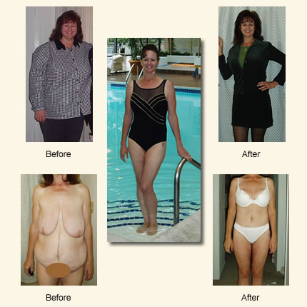 Body Lift,