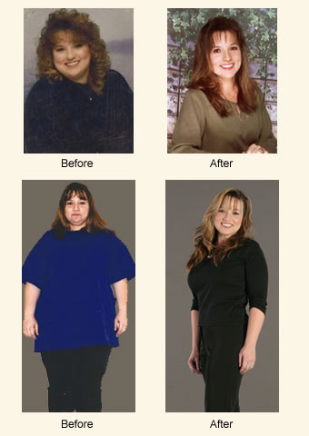 Dana, Age 36. Procedures: Lower Body Lift, Breast Lift with Implants. Weight Loss: 190 lbs