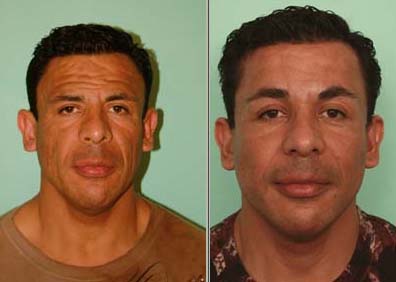 before and after male facelift