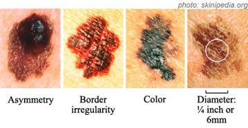 melanoma