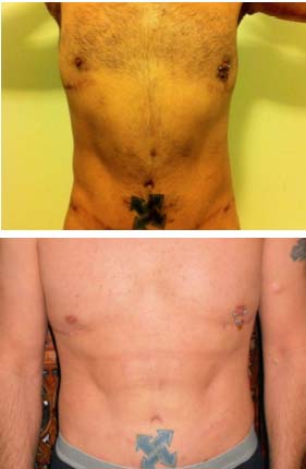 Abdominal Etching Before and After Pictures