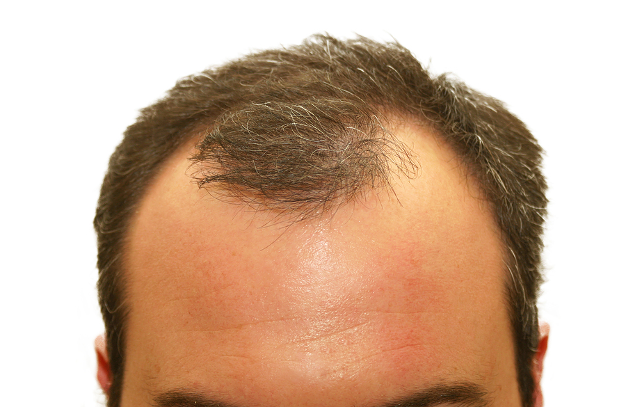 Male pattern baldness hair loss symptoms