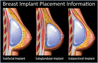 Breast implant placement