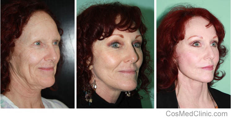 Face lift, Neck Lift Before and After Photos