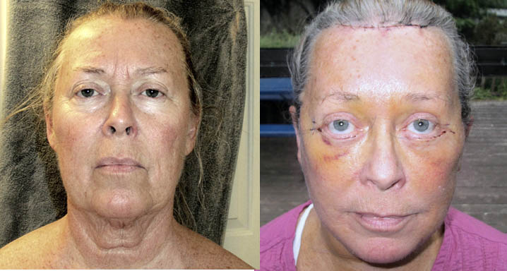 healing from face lift