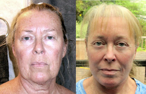 30 days after facelift mexico
