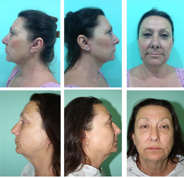 Before and After Facelift Surgery in Mexico