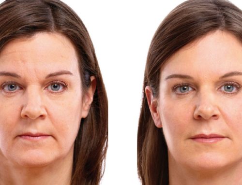 ¿CUÁNTO AHORRARÉ SI ME HAGO UN SOFT-LIFT EN MÉXICO?