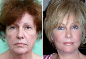 Facelift- cirugía plástica en paciente mujer. Cosmed Clinic