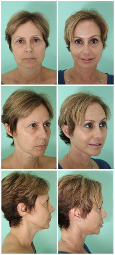 Facelift surgery in Cosmed Tijuana Mexico