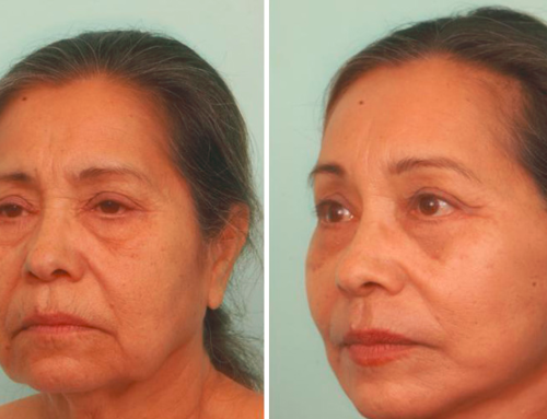 Facelifts: Are You Ready for a Change but Want Results that Look Natural? Consider Dr. Quiroz!