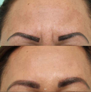 before and after botox. Frown lines 