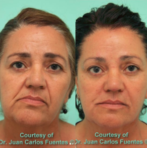 Before and after. Botox & Fillers.