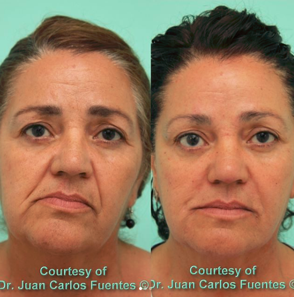 tijuana anti aging)