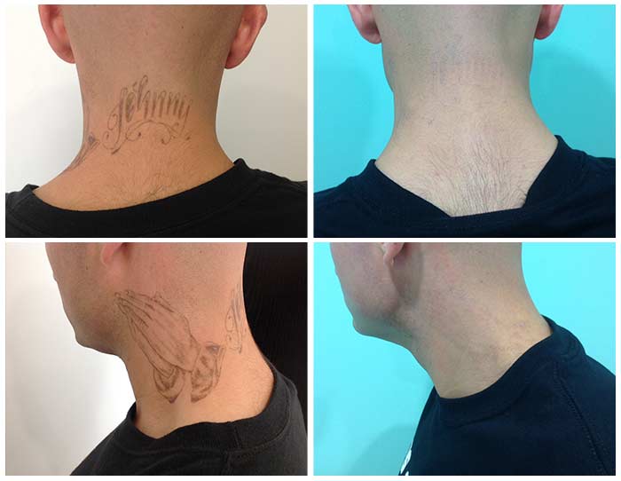 Tattoo Removal from Vida Wellness And Beauty Center