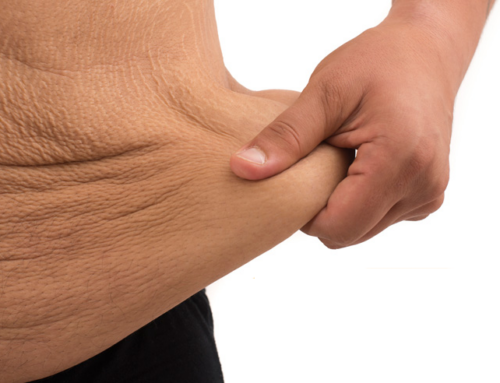 After weight-loss surgery with Dr. Quiroz