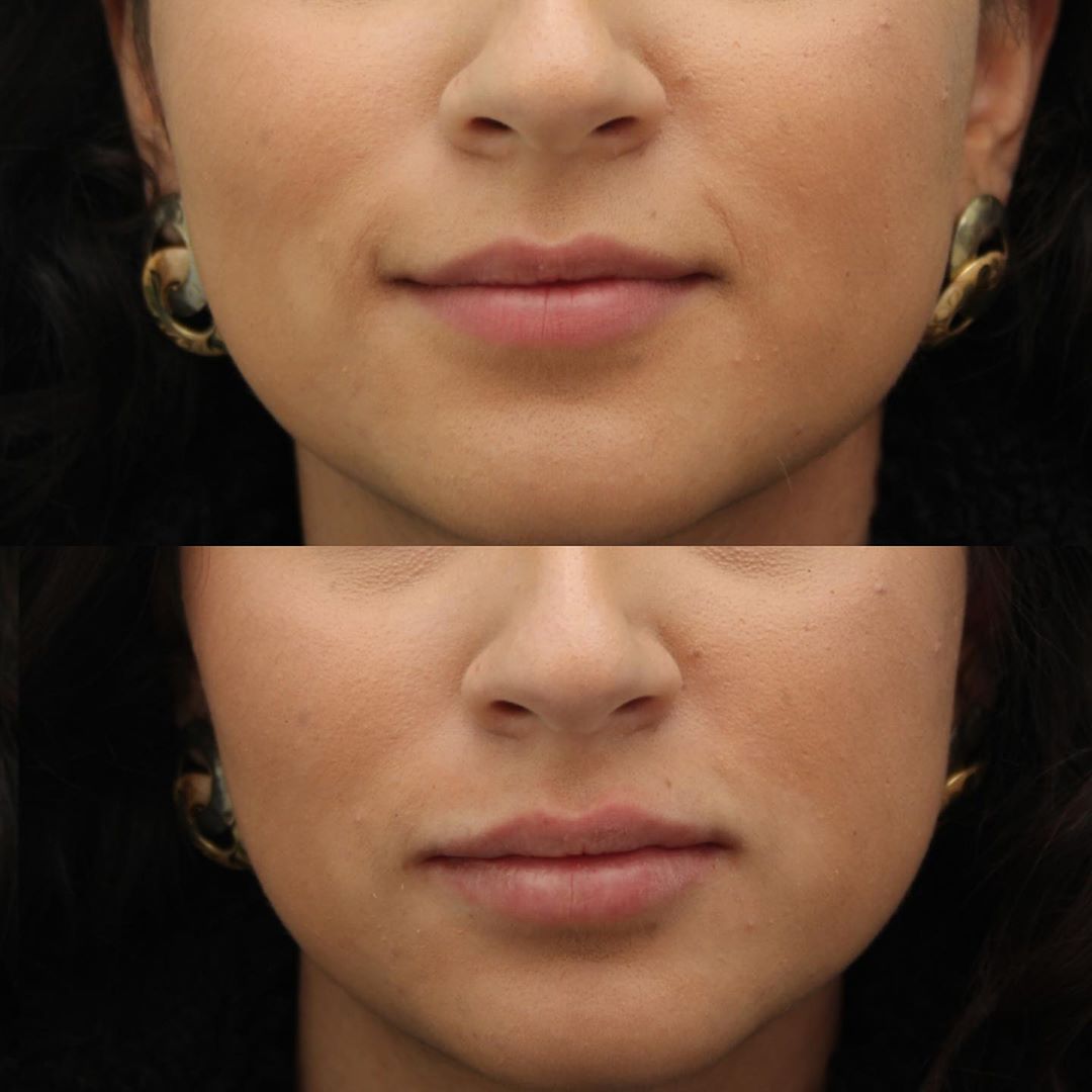 fillers, non-surgical treatment, botox, juvederm, beauty
