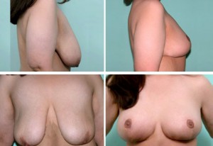 breast7